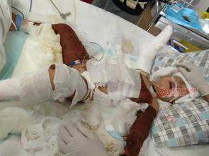 儿童烧伤图片,关爱与救治的紧急行动 第2张 儿童烧伤图片,关爱与救治的紧急行动 第2张